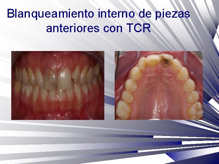 Blanqueamiento interno de piezas anteriores con TCR 