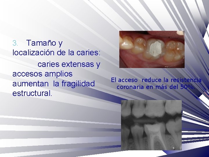 Tamaño y localización de la caries: caries extensas y accesos amplios aumentan la fragilidad