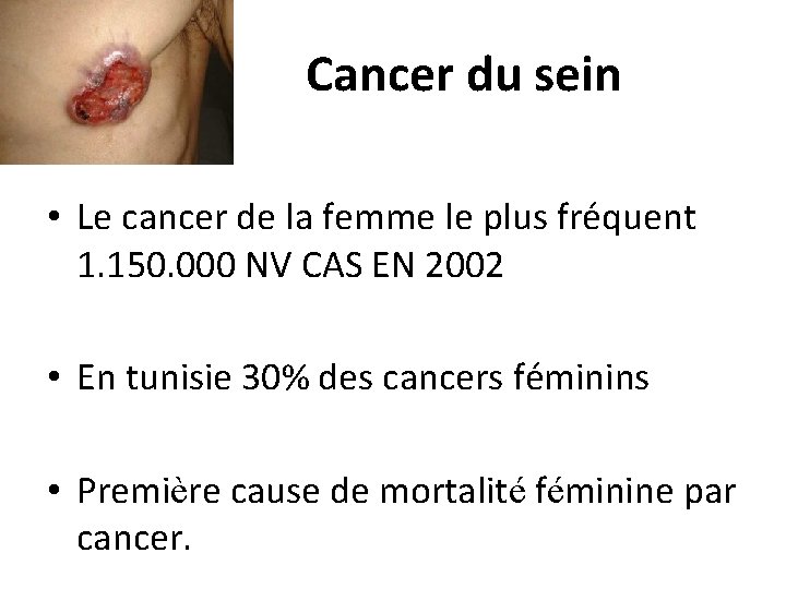 Cancer du sein • Le cancer de la femme le plus fréquent 1. 150.