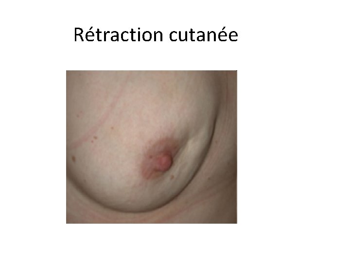 Rétraction cutanée 