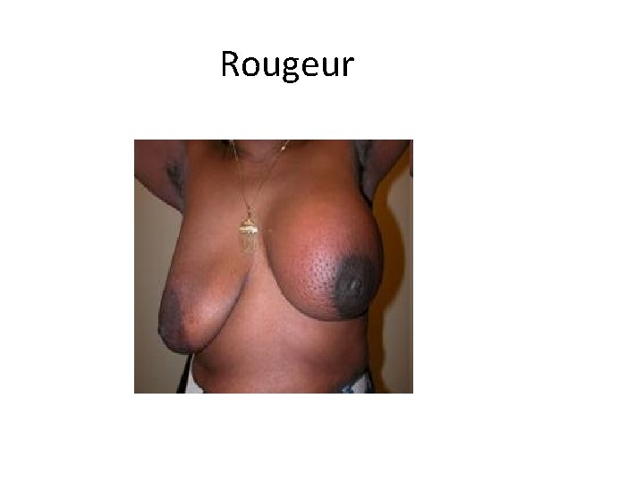 Rougeur 
