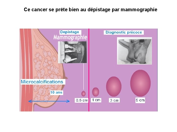 Ce cancer se prête bien au dépistage par mammographie 