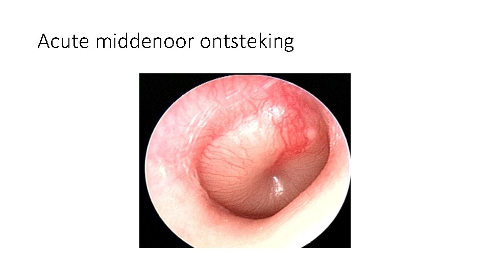 Acute middenoor ontsteking Acute middenoor ontsteking