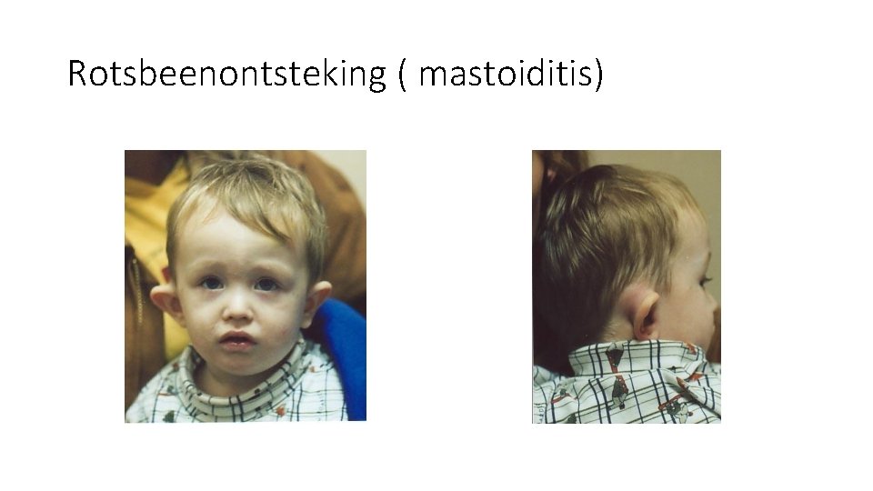 Rotsbeenontsteking ( mastoiditis) Rotsbeenontsteking ( mastoiditis)