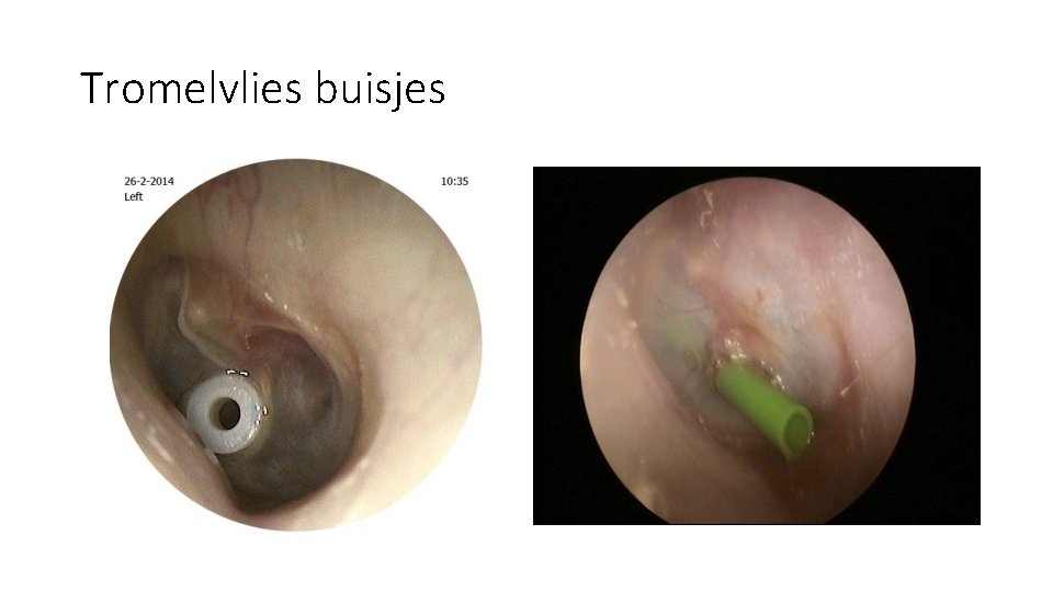 Tromelvlies buisjes Tromelvlies buisjes