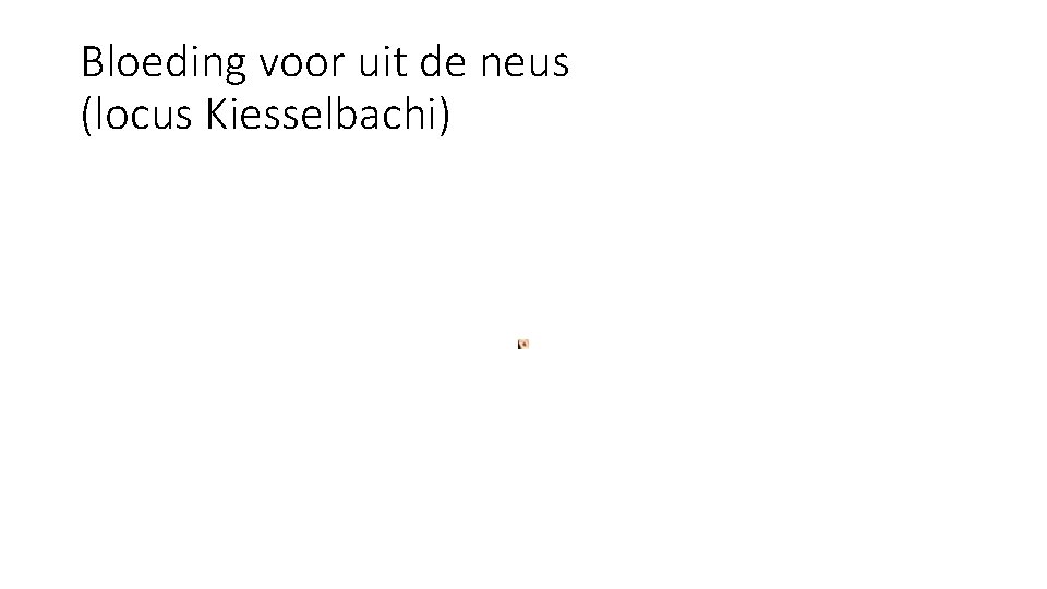 Bloeding voor uit de neus (locus Kiesselbachi) Bloeding voor uit de neus (locus Kiesselbachi)