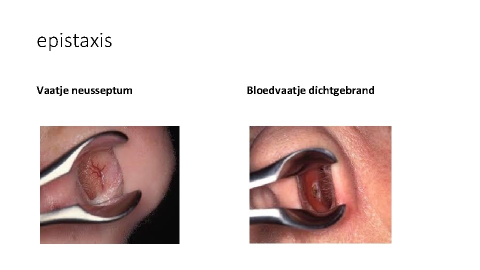 epistaxis Vaatje neusseptum Bloedvaatje dichtgebrand epistaxis Vaatje neusseptum Bloedvaatje dichtgebrand