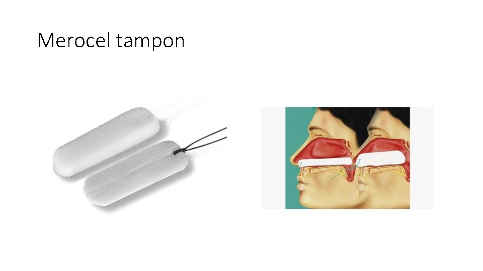 Merocel tampon Merocel tampon