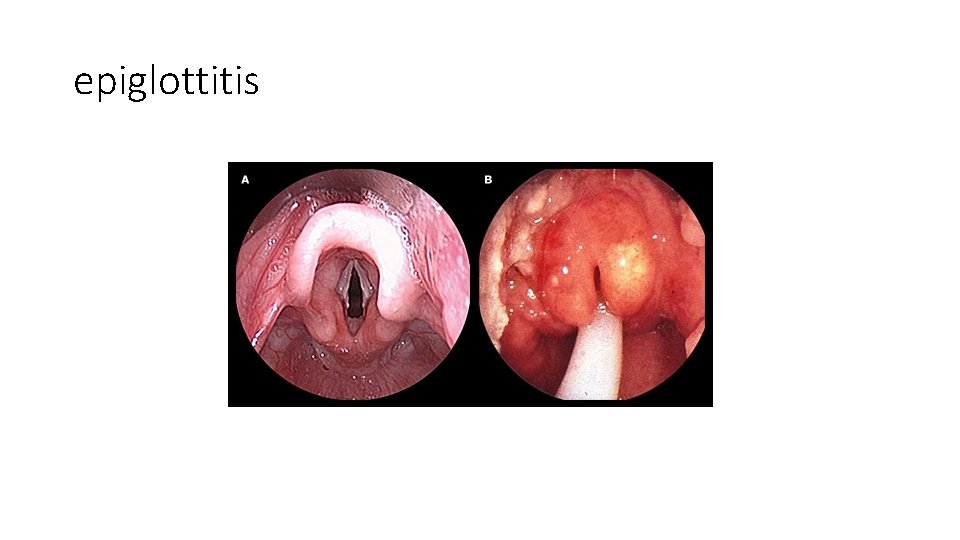 epiglottitis epiglottitis