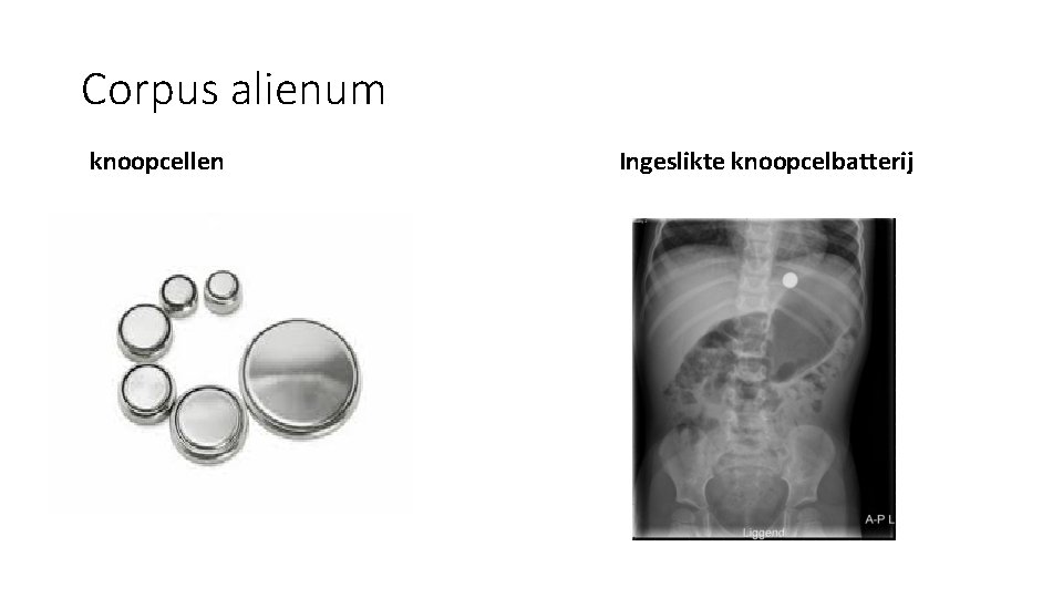Corpus alienum knoopcellen Ingeslikte knoopcelbatterij Corpus alienum knoopcellen Ingeslikte knoopcelbatterij