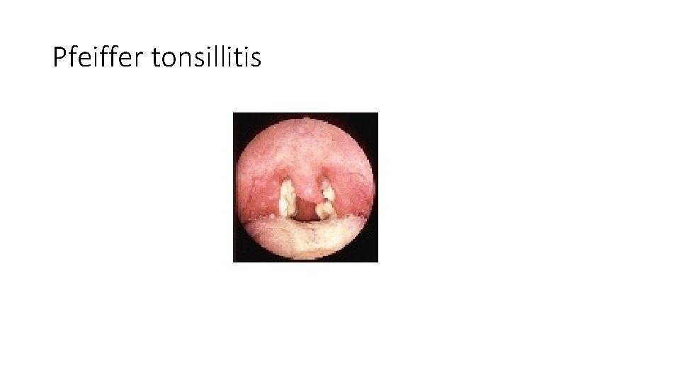 Pfeiffer tonsillitis Pfeiffer tonsillitis