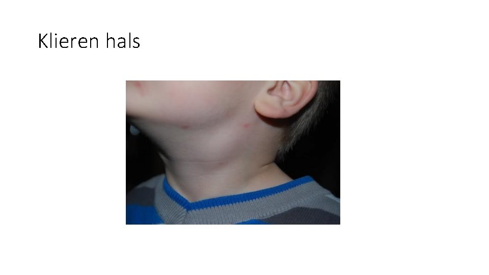 Klieren hals Klieren hals