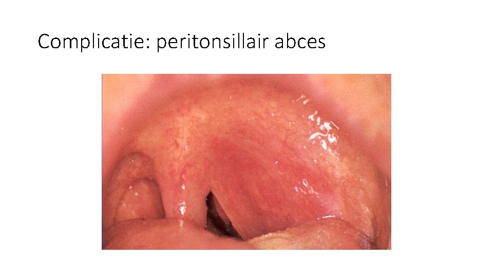 Complicatie: peritonsillair abces Complicatie: peritonsillair abces
