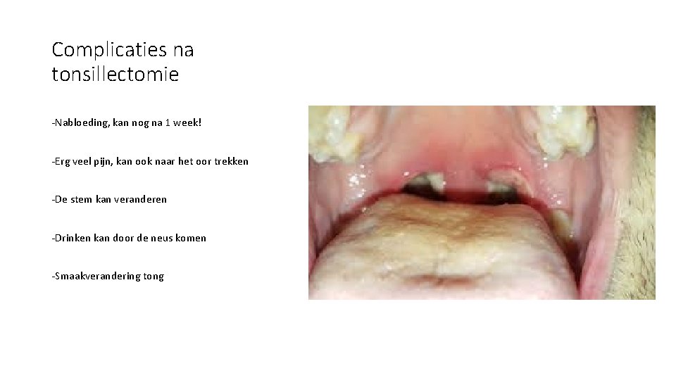 Complicaties na tonsillectomie -Nabloeding, kan nog na 1 week! -Erg veel pijn, kan ook Complicaties na tonsillectomie -Nabloeding, kan nog na 1 week! -Erg veel pijn, kan ook