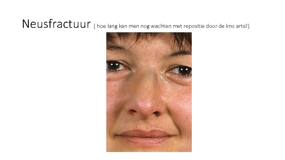 Neusfractuur ( hoe lang kan men nog wachten met repositie door de kno arts? Neusfractuur ( hoe lang kan men nog wachten met repositie door de kno arts?