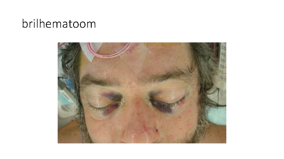 brilhematoom brilhematoom