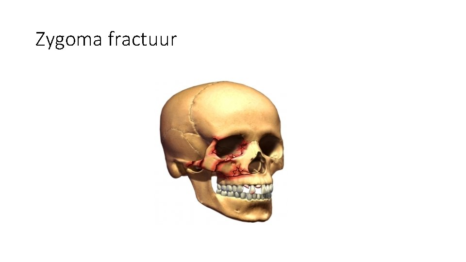 Zygoma fractuur Zygoma fractuur