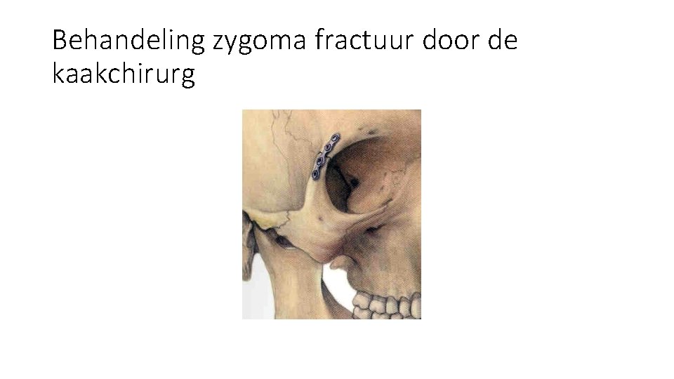 Behandeling zygoma fractuur door de kaakchirurg Behandeling zygoma fractuur door de kaakchirurg