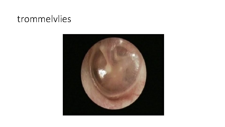 trommelvlies trommelvlies