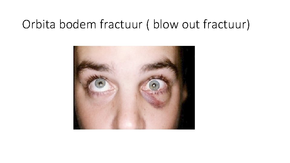 Orbita bodem fractuur ( blow out fractuur) Orbita bodem fractuur ( blow out fractuur)
