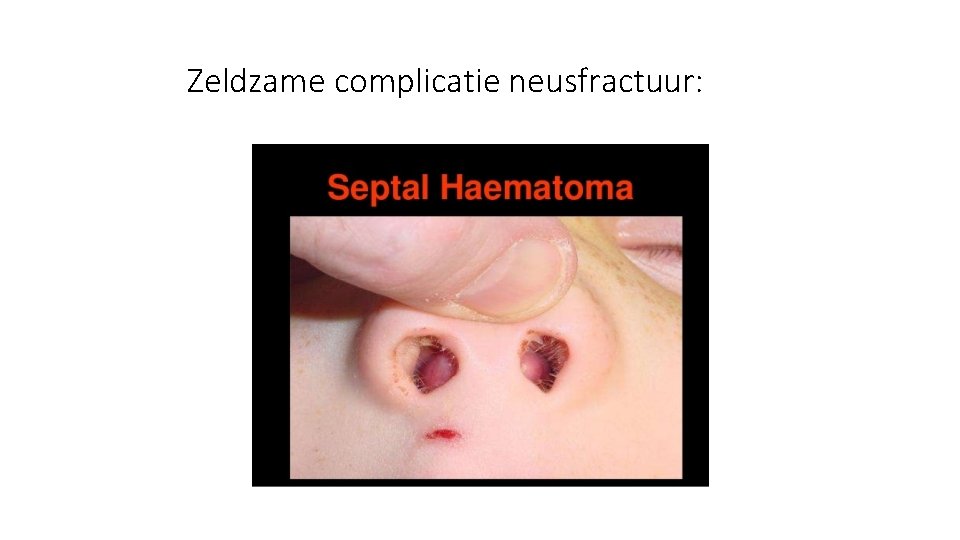 Zeldzame complicatie neusfractuur: Zeldzame complicatie neusfractuur: