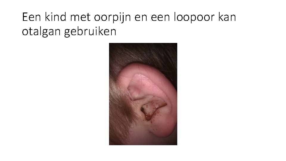 Een kind met oorpijn en een loopoor kan otalgan gebruiken Een kind met oorpijn en een loopoor kan otalgan gebruiken