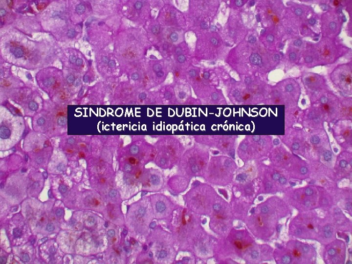 SINDROME DE DUBIN-JOHNSON (ictericia idiopática crónica) 