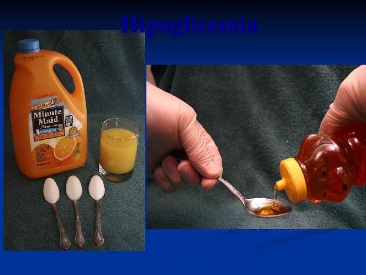 Hipoglicemia Hipoglicemia