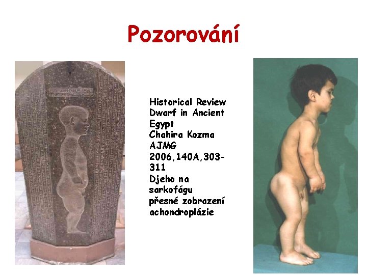 Pozorování Historical Review Dwarf in Ancient Egypt Chahira Kozma AJMG 2006, 140 A, 303311