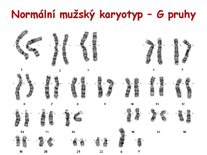 Normální mužský karyotyp – G pruhy 