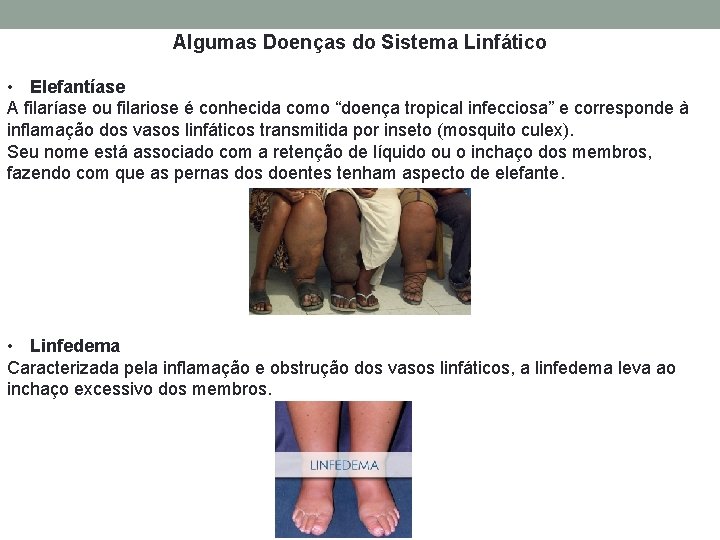 Algumas Doenças do Sistema Linfático • Elefantíase A filaríase ou filariose é conhecida como