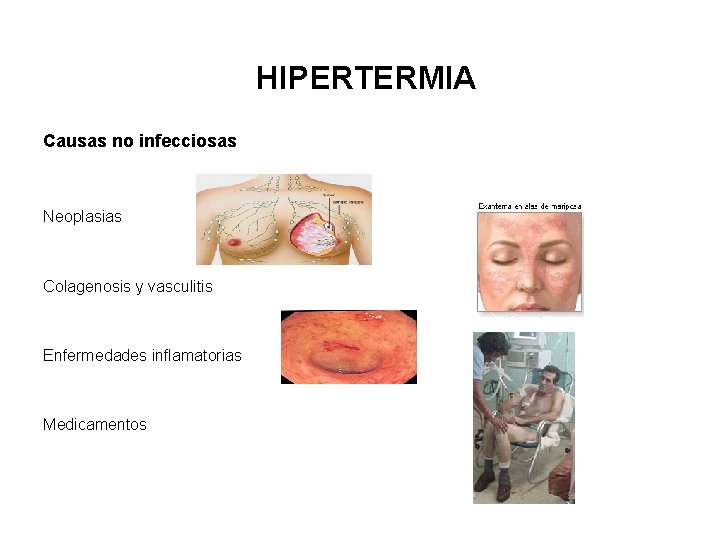 HIPERTERMIA Causas no infecciosas Neoplasias Colagenosis y vasculitis Enfermedades inflamatorias Medicamentos 