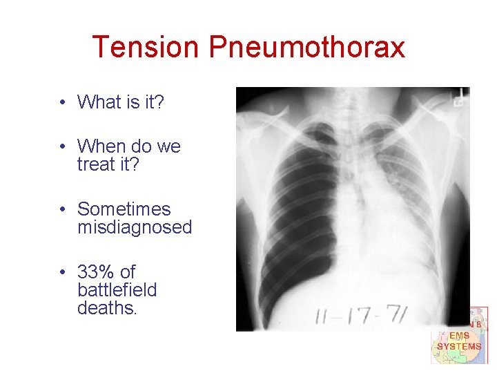 Tension Pneumothorax • What is it? • When do we treat it? • Sometimes