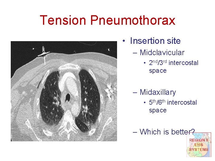 Tension Pneumothorax • Insertion site – Midclavicular • 2 nd/3 rd intercostal space –