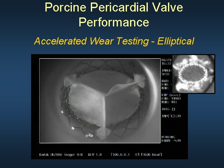 Porcine Pericardial Valve Performance Accelerated Wear Testing - Elliptical Porcine Pericardial Valve Performance Accelerated Wear Testing - Elliptical