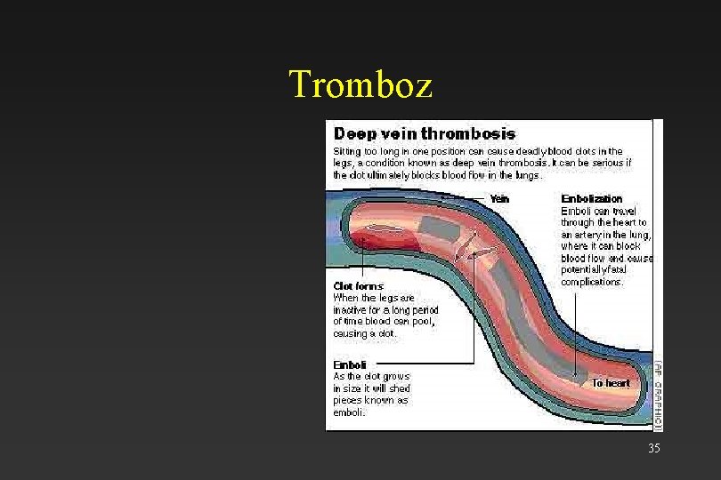 Tromboz 35 