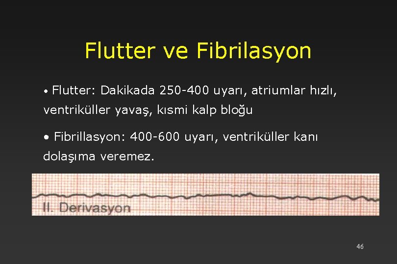 Flutter ve Fibrilasyon • Flutter: Dakikada 250 -400 uyarı, atriumlar hızlı, ventriküller yavaş, kısmi