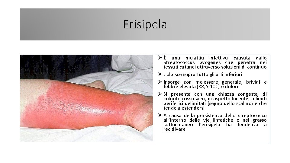 Erisipela Ø È una malattia infettiva causata dallo Streptococcus pyogenes che penetra nei tessuti