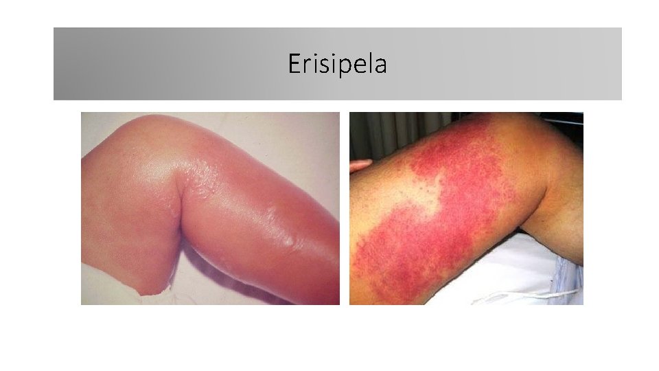 Erisipela 