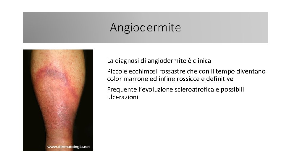 Angiodermite La diagnosi di angiodermite è clinica Piccole ecchimosi rossastre che con il tempo