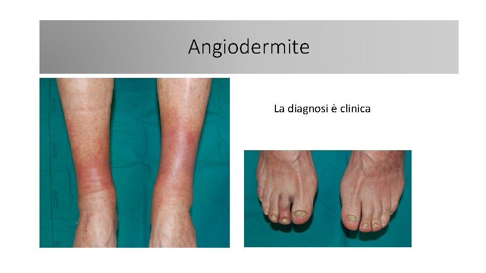 Angiodermite La diagnosi è clinica 