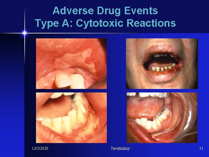 Adverse Drug Events Type A: Cytotoxic Reactions 12/3/2020 Terezhalmy 51 