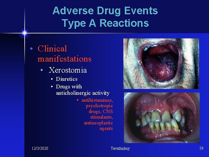 Adverse Drug Events Type A Reactions • Clinical manifestations • Xerostomia • Diuretics •