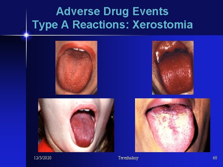 Adverse Drug Events Type A Reactions: Xerostomia 12/3/2020 Terezhalmy 60 