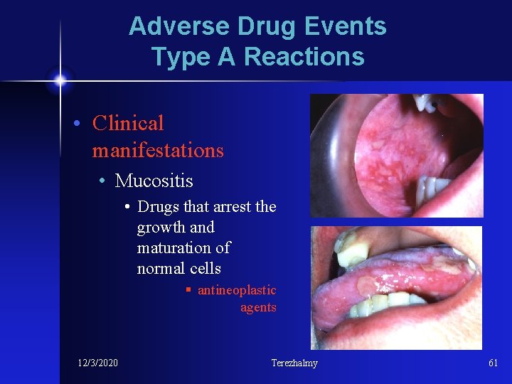 Adverse Drug Events Type A Reactions • Clinical manifestations • Mucositis • Drugs that