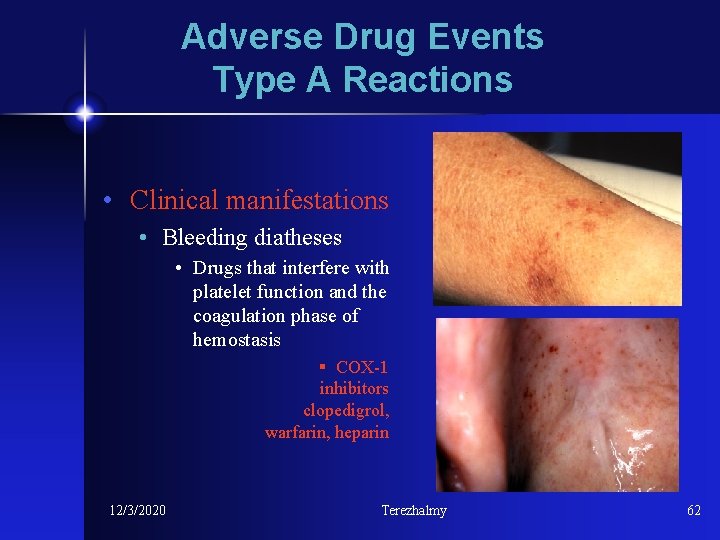 Adverse Drug Events Type A Reactions • Clinical manifestations • Bleeding diatheses • Drugs