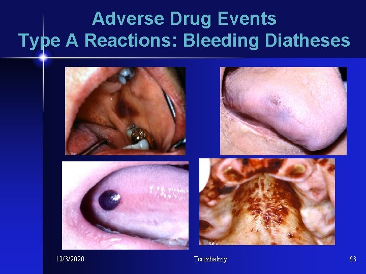 Adverse Drug Events Type A Reactions: Bleeding Diatheses 12/3/2020 Terezhalmy 63 