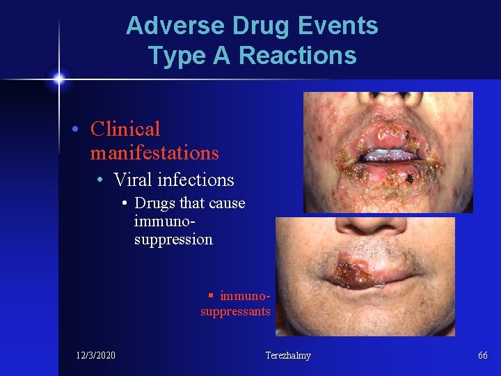 Adverse Drug Events Type A Reactions • Clinical manifestations • Viral infections • Drugs