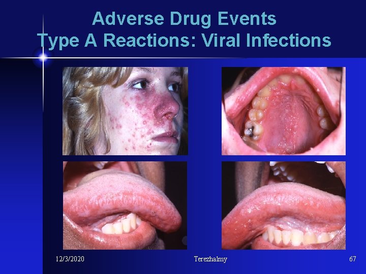 Adverse Drug Events Type A Reactions: Viral Infections 12/3/2020 Terezhalmy 67 