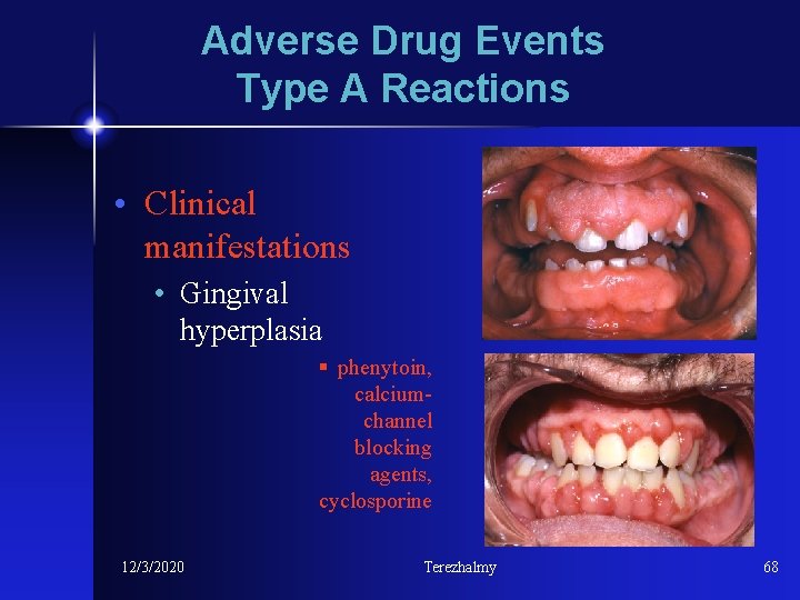 Adverse Drug Events Type A Reactions • Clinical manifestations • Gingival hyperplasia § phenytoin,